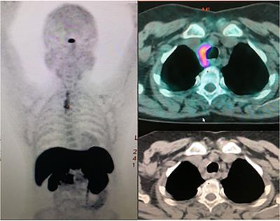 Recurrent parathyromatosis in a patient with concomitant MEN1 and CASR gene alterations: Clinical management of a case report and literature review